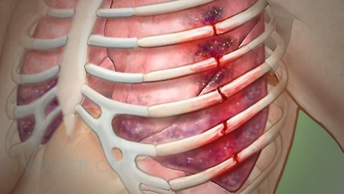 Код мкб проникающее ранение грудной клетки