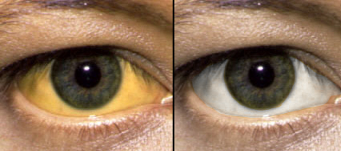 Синдром Жильбера - способы лечения