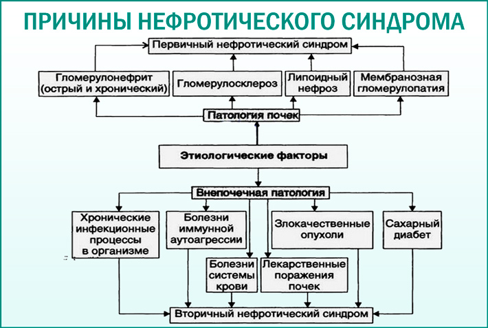 Причины нефротического синдрома Нефротический синдром: причины