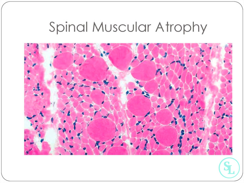 Синдром правой сма что это