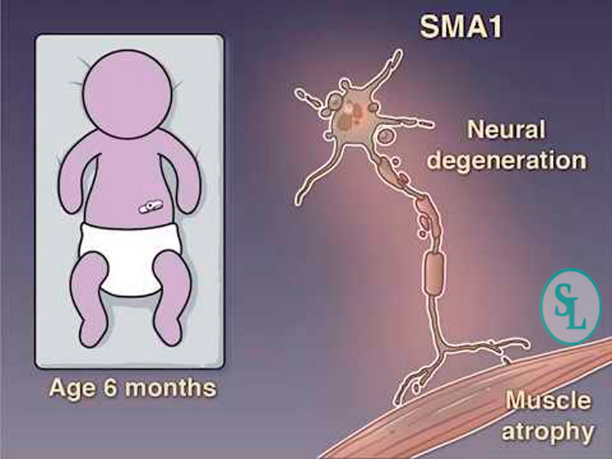 Синдром правой сма что это