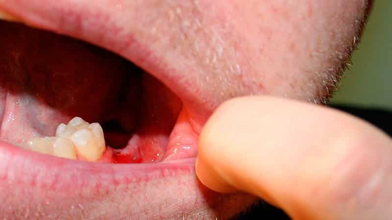 Сухая лунка после удаления зуба мудрости