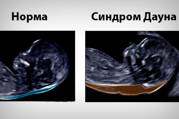 УЗИ болезнь Дауна УЗИ болезнь Дауна