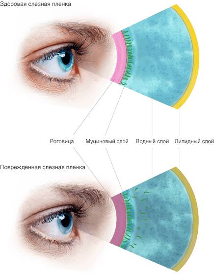 Здоровая и поврежденная слезная пленка