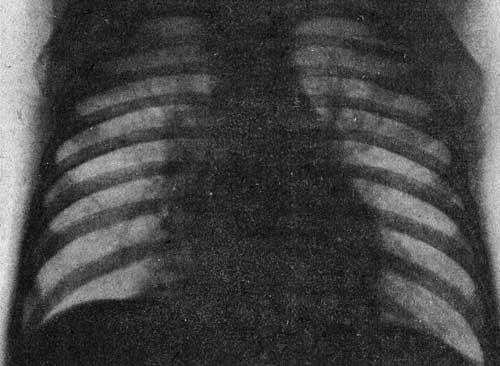Двусторонняя пневмония, вызванная аденовирусной инфекцией