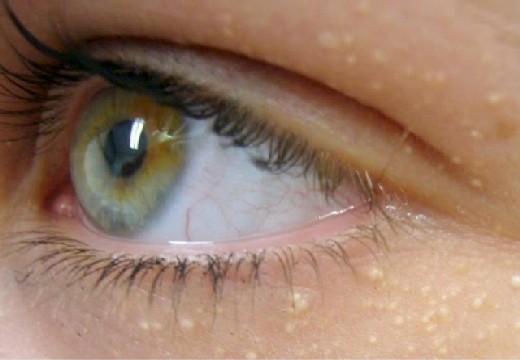 жировики вокруг глаз