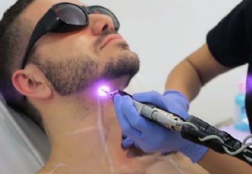 удаление лазером