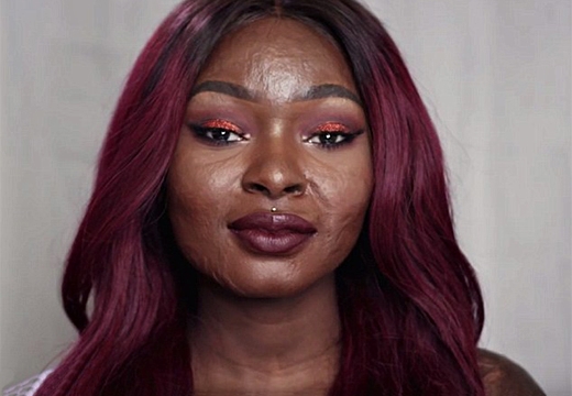 девушка с ожогами кожи