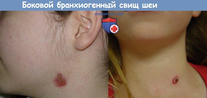 Боковой бранхиогенный свищ шеи
