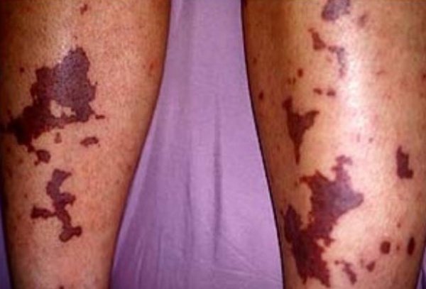 Геморрагические элементы на коже при ДВС-синдроме Геморрагические элементы на коже при ДВС-синдроме