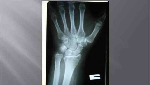 Перелом шиловидного отростка код мкб