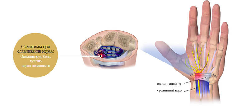 Эти 5 упражнений помогут при синдроме запястного канала Эти 5 упражнений помогут при синдроме запястного канала