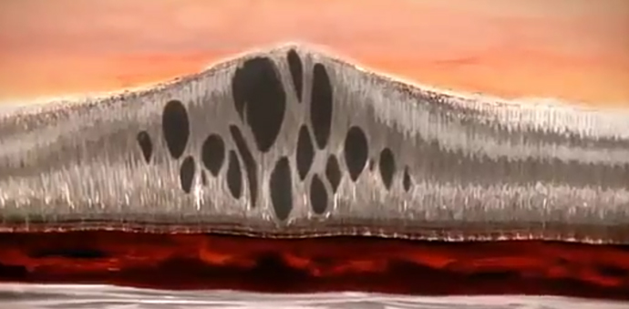 Витреомакулярный тракционный синдром по мкб 10