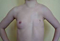 Синдром Поланда Синдром Поланда