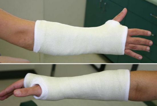 Рука в гипсе