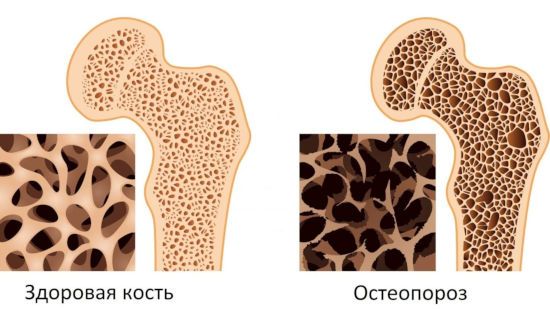 Кость при остеопорозе