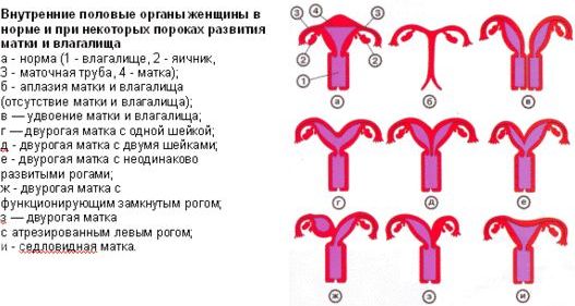 Варианты двурогой матки