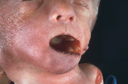 лицевые аномалии трисомии 18