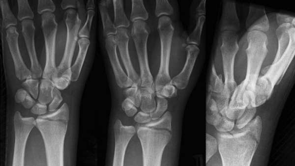 Перелом шиловидного отростка код мкб