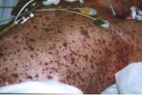 ДВС-синдром ДВС-синдром