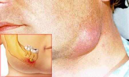 Фото флегмоны