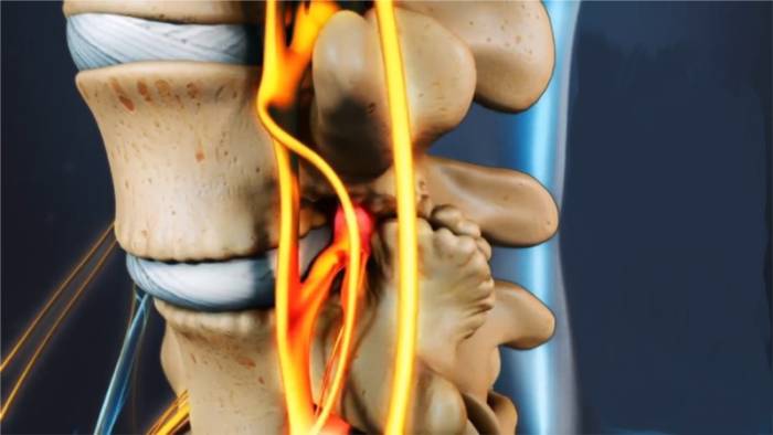 При сдавливании нерв воспаляется, в месте защемления возникает отек и боль