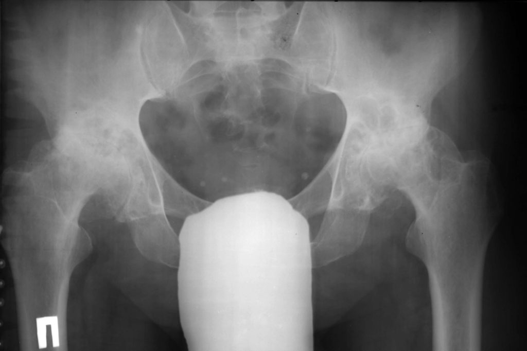 Артрозо артрит тазобедренного сустава код мкб 10