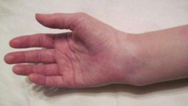 Перелом шиловидного отростка код мкб