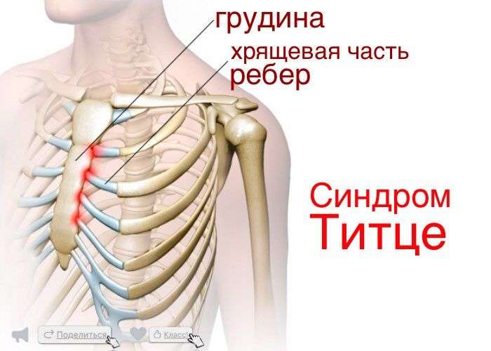 Синдром Титце. Реберный перихондрит