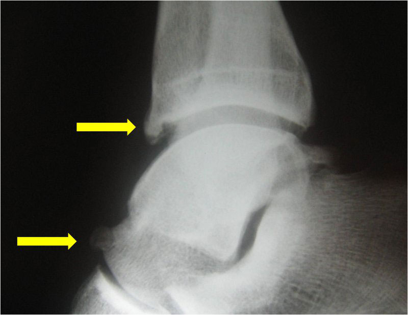 Задний импинджмент синдром голеностопного сустава мрт