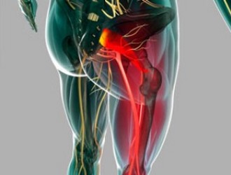 Причины спазма грушевидной мышцы делятся на два типа: вертеброгенные и невертеброгенные