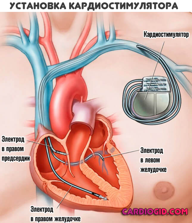 кардиостимулятор