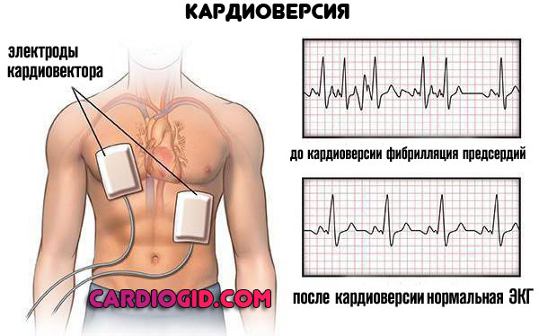 кардиоверсия