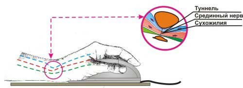 Карпальный туннельный синдром запястья Карпальный туннельный синдром запястья
