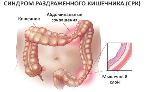 Термин используемый для описания типа пищеварительного расстройства, которое характеризуется группой распространенных симптомов, включая изменения в дефекации и боли в животе.
