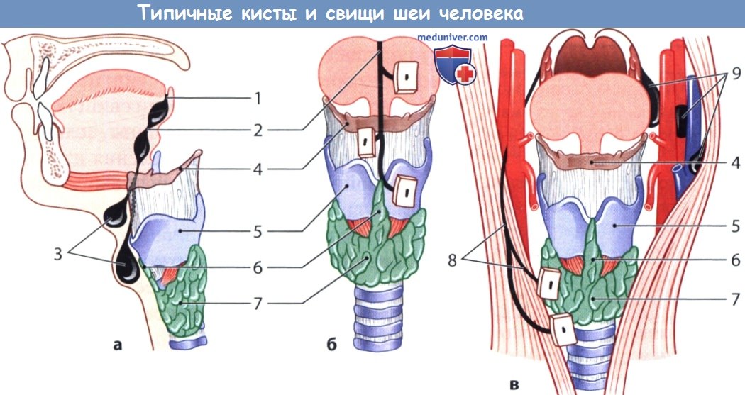 Кисты и свищи шеи человека