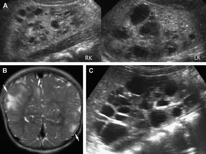 Киста почки код по МКБ 10