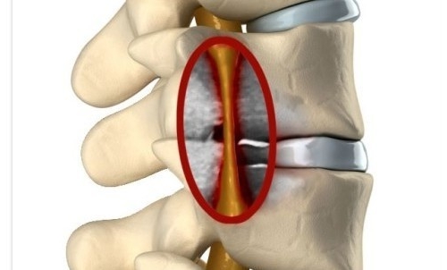Корешковый синдром