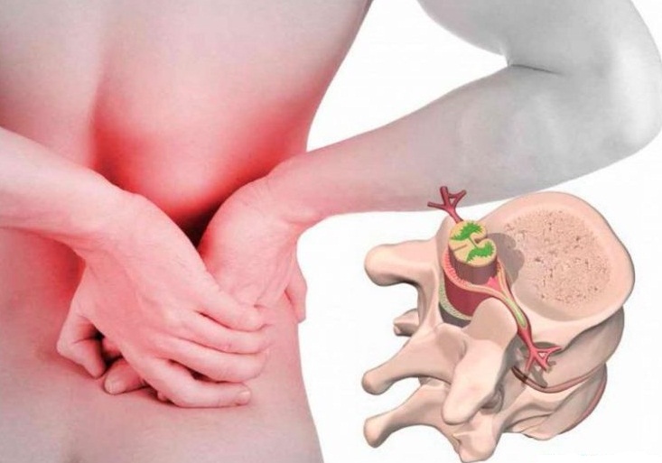 Корешковый синдром поясничного отдела: симптомы, лечение