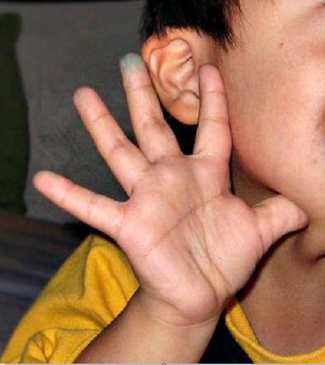 ладонная складка