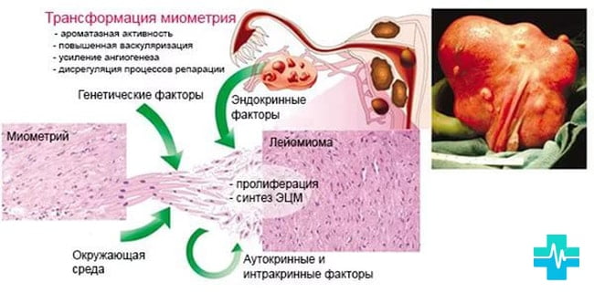 Лейомиома матки с геморрагическим синдромом