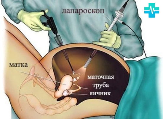 Лейомиома матки с геморрагическим синдромом