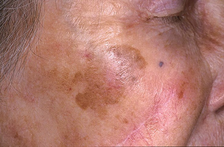 Проявления лентигиноза