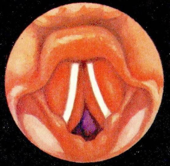 Стеноз гортани при ложном крупе