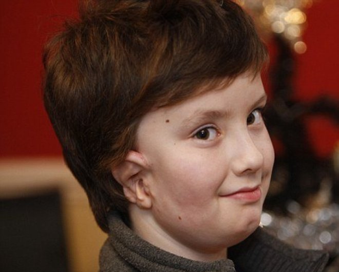 Проявление синдрома Гольденхара 