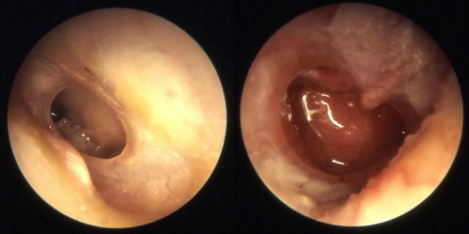 диагностика мезотимпанита