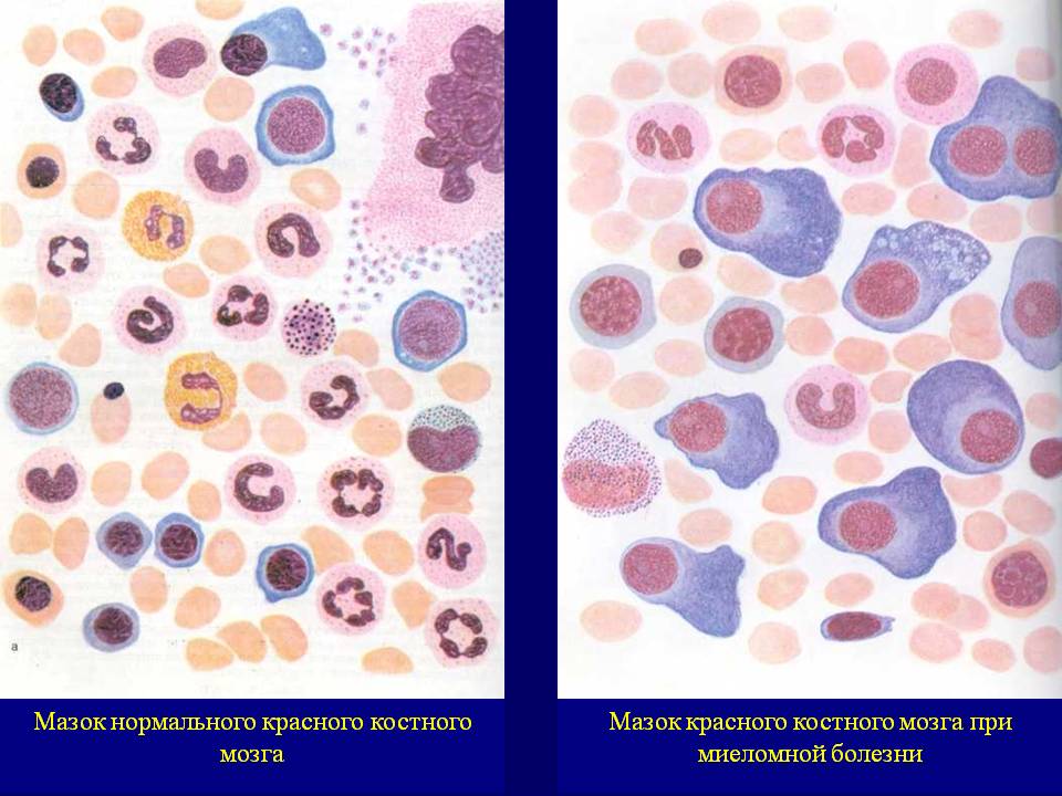 Клетки костного мозга при миеломной болезни
