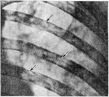 Повреждения ребер при миеломной болезни