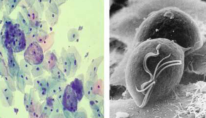 Микрофотографии Gardnerella vaginalis Бактериальный вагиноз