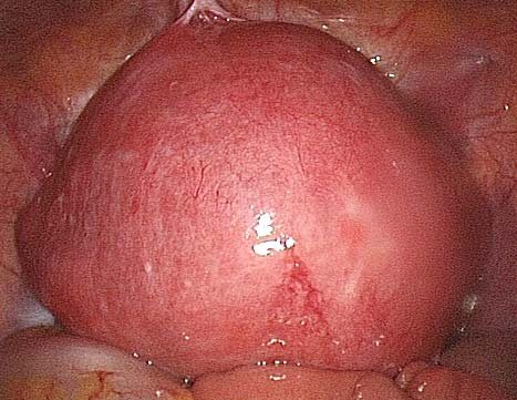 Узел миомы матки больших размеров